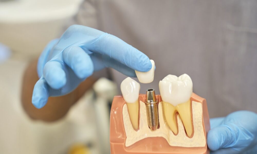 who-is-a-good-candidate-for-dental-implants?